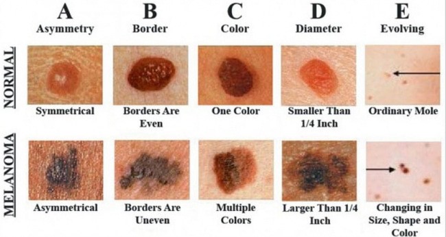 abu dhabi skin cancer signs 1