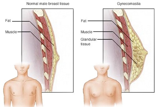 Gynecomastia Male Breast Reduction Abu Dhabi Breast Surgeries